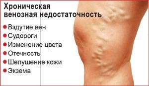 Венозна недостатність: симптоми і лікування