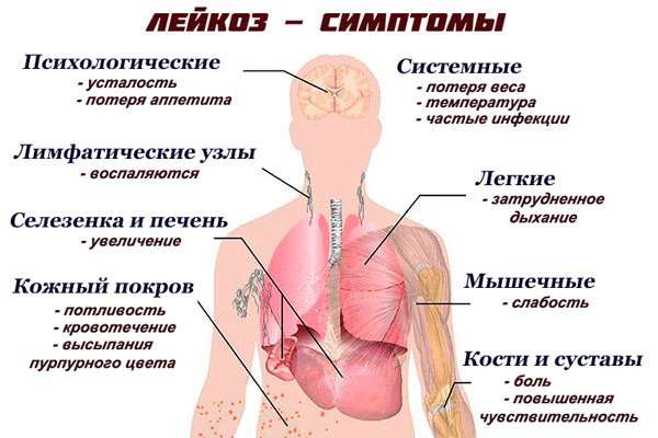 Гострий лейкоз: симптоми і лікування