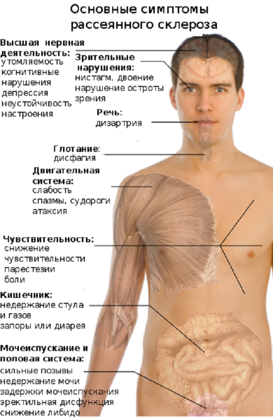 Розсіяний склероз: симптоми і лікування