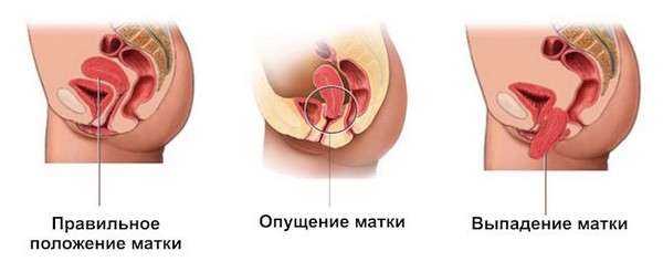 Випадання матки: симптоми і лікування