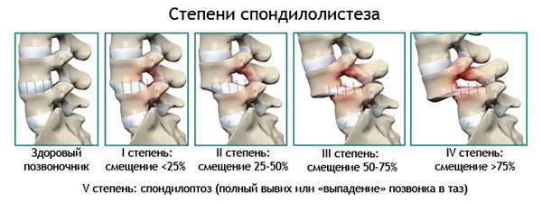 Зміщення хребців: симптоми і лікування