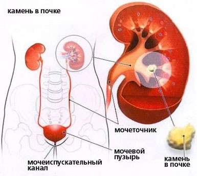 Сечокамяна хвороба (уролітіаз): симптоми і лікування