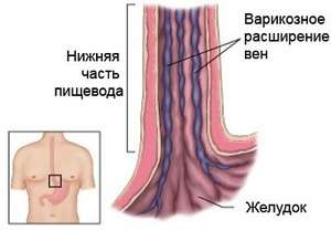 Ерозивний гастрит: симптоми і лікування