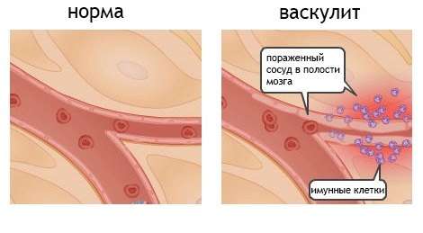 Системний васкуліт: симптоми і лікування