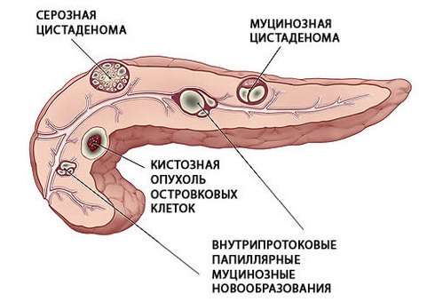 Кіста підшлункової залози: симптоми і лікування