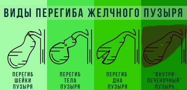 Перегин жовчного міхура: симптоми і лікування