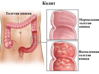 Коліт у дітей: симптоми і лікування